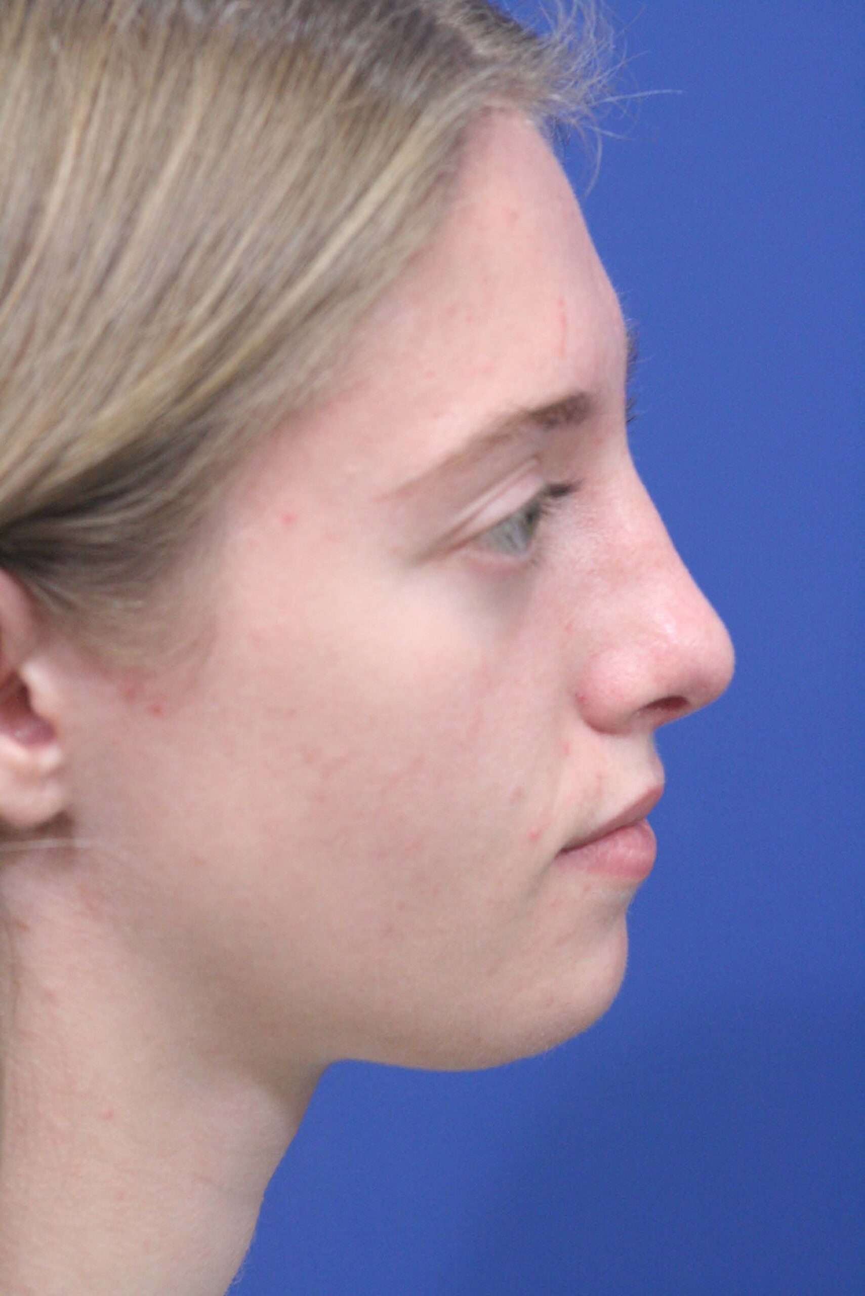After Rhinoplasty and Chin Implant