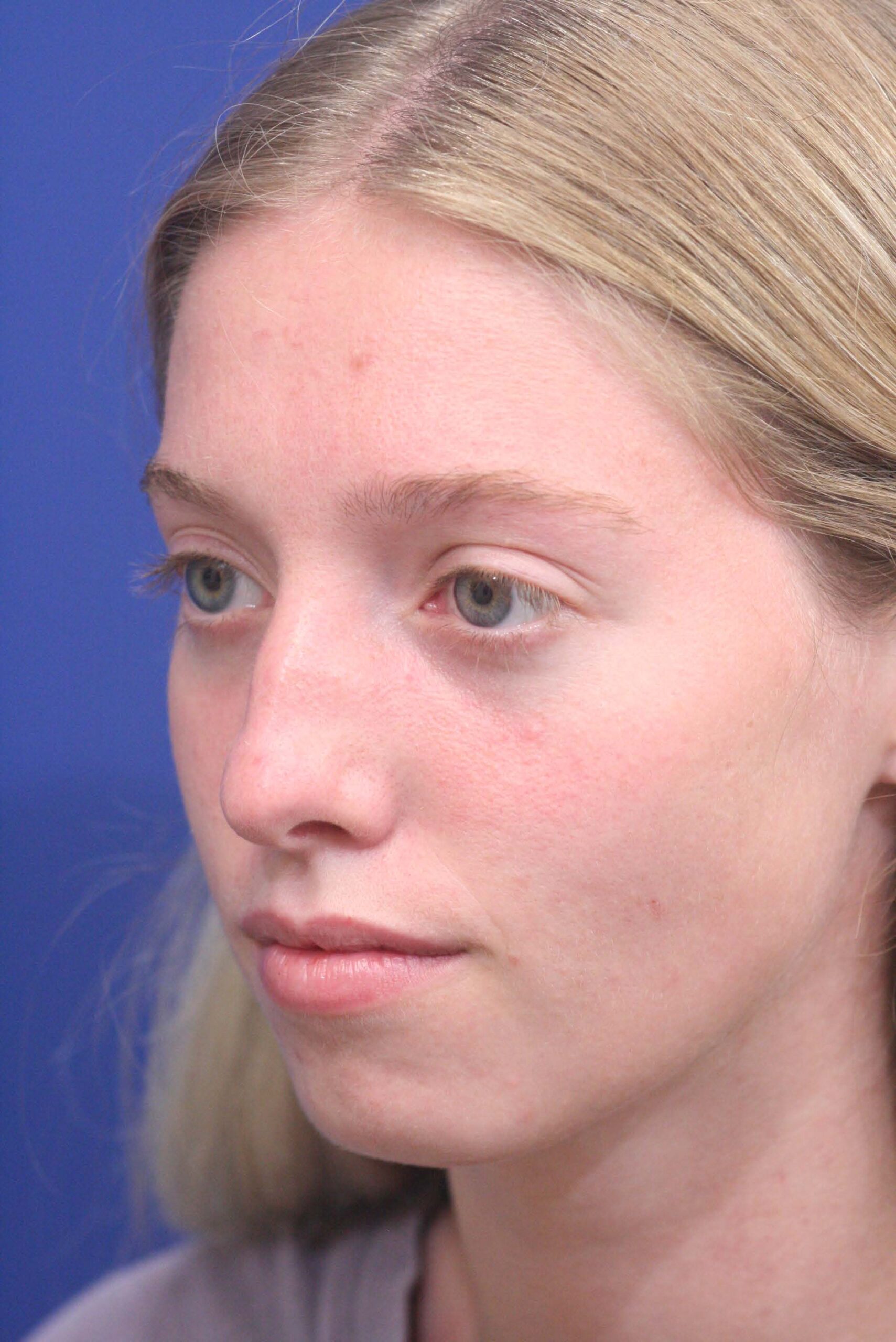 After Rhinoplasty and Chin Implant